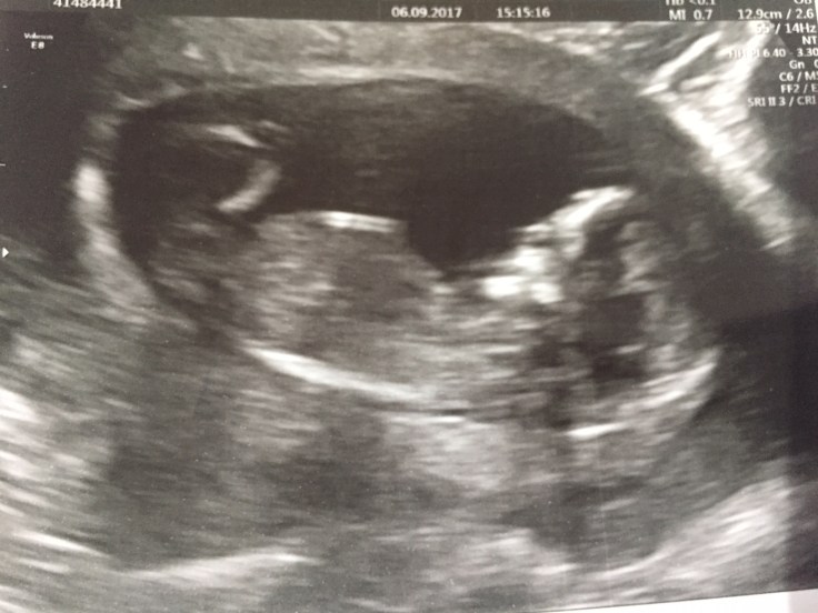 13 week scan